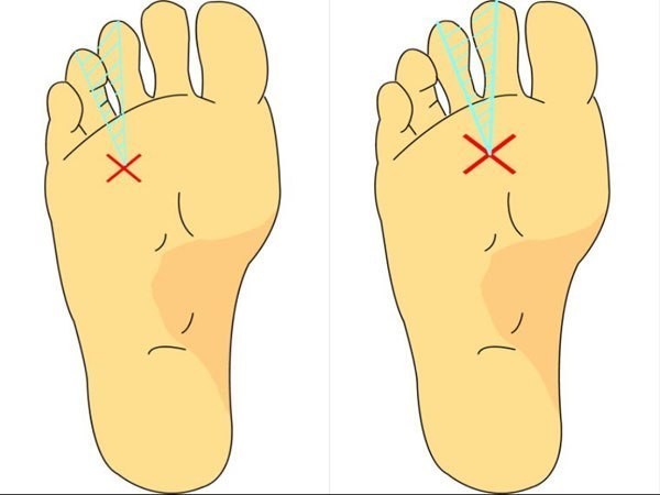 病 治療 モートン 足裏の痛み・痺れは自分で治せる！モートン病の5つの治療法！